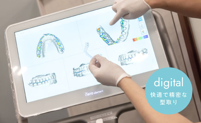 快適で精密な型取り