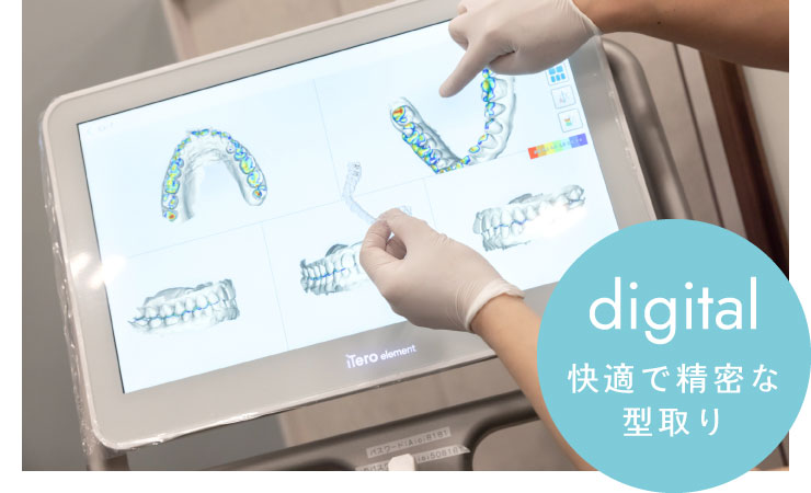 快適で精密な型取り