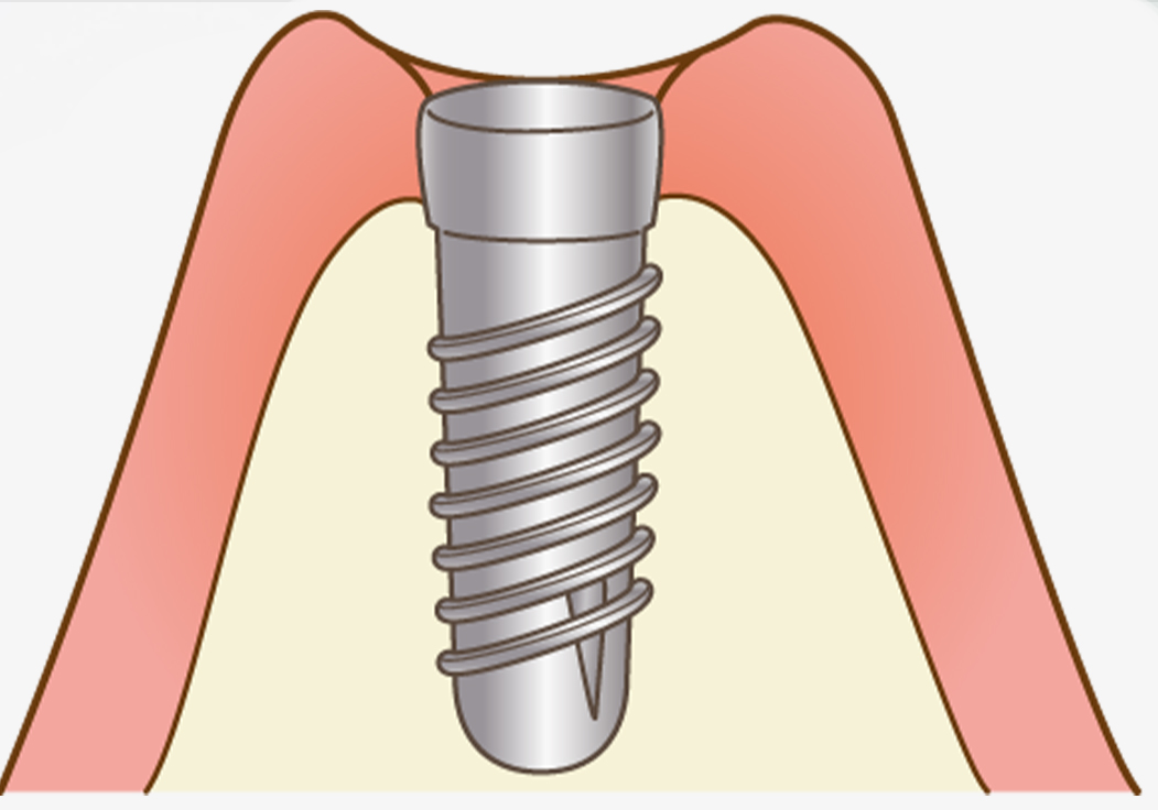 インプラント