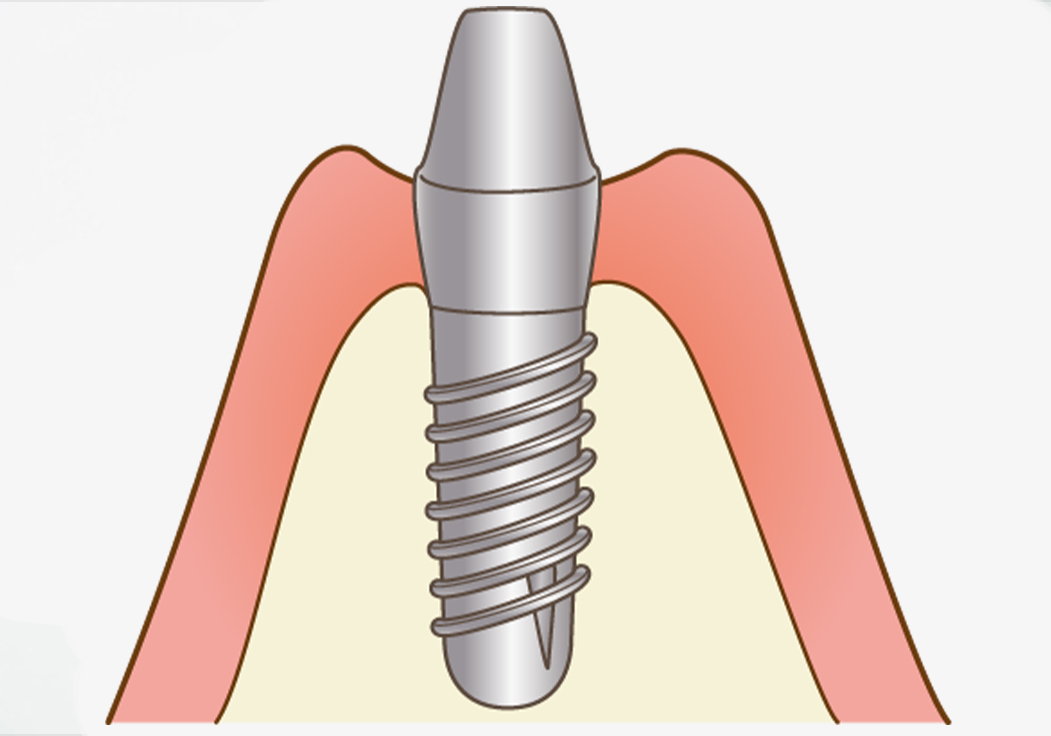 インプラント