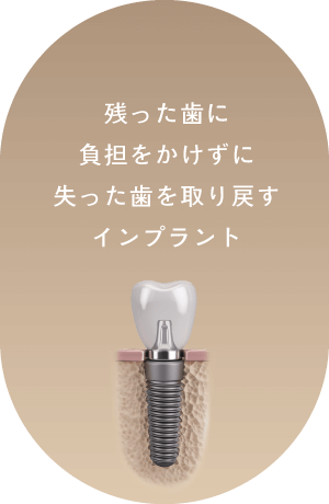残った歯に負担をかけずに失った歯を取り戻すインプラント