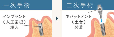 2回法