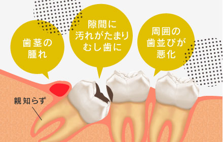 「歯茎の腫れ」「隙間に汚れがたまりむし歯に」「周囲の歯並びが悪化」